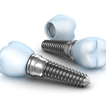 Dental Implants – Dental Solutions